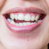 women with traumatic dental injury